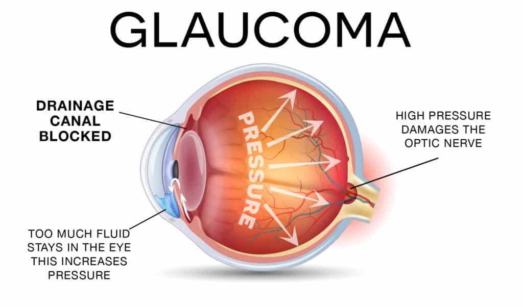 glaucoma 1024x602 1
