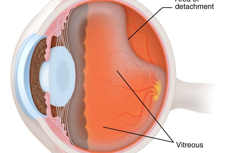 Retinal Detachment uai