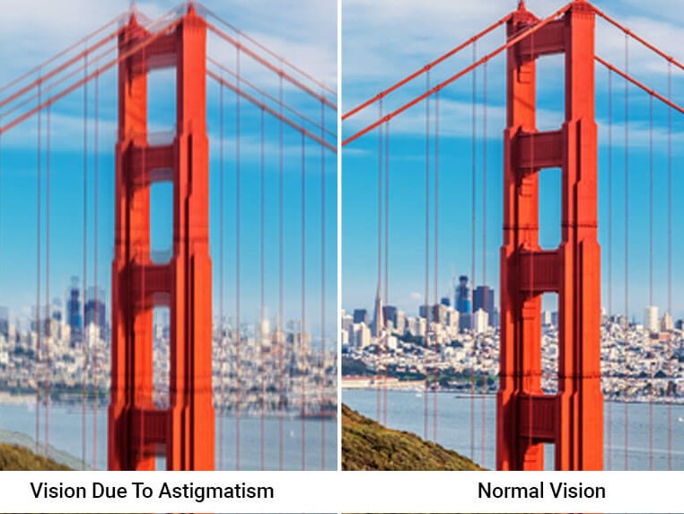 astigmatism vision uai