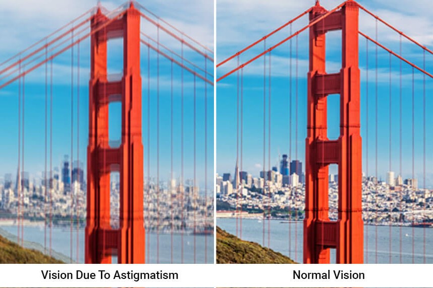 astigmatism vision uai